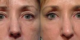 From Drab to Fab with Upper and Lower Eyelid Surgery in New York City, NY