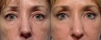 From Drab to Fab with Upper and Lower Eyelid Surgery in New York City, NY